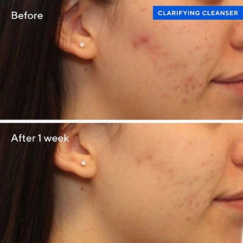 Image 1, before and after 1 week. image 2, 97% said it dissolves excess oil in a 3 day clinical study. image 3, salicylic acid reduces the severity of blemishes, helps keep skin clear by preventing formation of new blemishes and allows skin to heal. green tea extract helps soothe irritation for clearer, healthier looking skin. image 4, your breakout busting regimen. fast acting treatments that work. 1 = cleanse with clarifying cleanser, rinse and pat dry. 2 = dispense clarifying toner onto a cotton pad and sweep over face and neck. 3 - spot treat breakouts with rapid relief blemish spot treatment. 4 = oil and pore control mattifier SPF 45, during the day  apply oil and pore control mattifier to face and neck