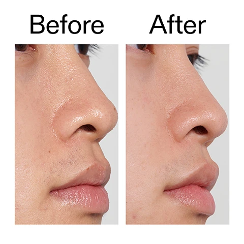 Image 1 - A before and after comparison image showing a persons side profile from the nose down to the mouth, with the left image showing slightly coarser skin and less defined features, and the right image showing smoother skin and more refined features, labeled Before and After. Image 2 - A close-up of a persons eyes, nose, and upper cheeks with freckles and two small silver nose studs, above the text Why we love it, Lightweight and refreshing texture, Great for sensitive skin or acid beginners, Gently smooths, hydrates and brightens. Image 3 - A clear liquid drop is displayed on a white background, with text that explains: Why it works 3% Polyhydroxy Acid (Gluconolactone) GENTLY EXFOLIATES AND SMOOTHS SKIN. 3% Niacinamide REDUCES SHINE AND IMPROVES UNEVEN TONE. Aloe Barbadensis Leaf Juice NATURALLY CALMING AND SOOTHING. Image 4 - A white background image displays usage instructions: How to use USE AM + PM. 1-2 DROPS. PAT INTO FACE AND NECK. AFTER CLEANSER, BEFORE MOISTURISER AND SPF IN THE AM. Image 5 - A white graphic depicting a skincare routine layering guide, featuring a translucent, textured overlay with small bubbles on the left, and the text How to layer your routine alongside a numbered list: 1 CLEANSE, 2 HYDRATE, 3 TREAT, 4 MOISTURISE, 5 SPF.