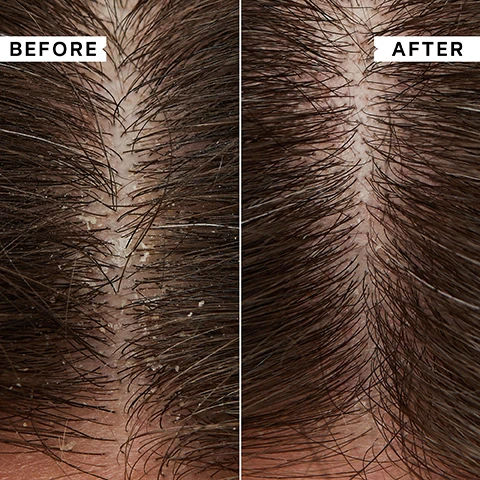 Image 1 - A split image of a scalp with dark hair shows a before and after comparison: the left side, labeled BEFORE, has visible dandruff flakes, while the right side, labeled AFTER, is significantly clearer. Image 2 - A hand holds a white tube of Philip Kingsley Flaky / Itchy Scalp Hydrating Conditioner, which displays PHILIP KINGSLEY FLAKY / ITCHY SCALP Hydrates, detangles and nourishes dry hair. Hydrate, démêle et nourrit les cheveux secs. HYDRATING CONDITIONER APRÈS-SHAMPOOING HYDRATANT 200ml e 6.76 fl oz, and to the right, text reads KEY BENEFITS Super-lightweight formula delivers concentrated hydration, Doesnt weigh hair down, Suitable for oily or limp hair. Image 3 - A white tube of Philip Kingsley Flaky / Itchy Scalp Hydrating Conditioner with a white dollop of product on top is shown, with the visible text Philip Kingsley Flaky / Itchy Scalp Hydrating Conditioner 200ml e 6.76 fl.oz., 90% reported hair felt MOISTURISED after use, and Independent User Trial Results. Image 4 - A white Philip Kingsley Flaky / Itchy Scalp Hydrating Conditioner Aprés-Shampooing Hydratant 200ml e 6.7 fl oz tube with a swirl of white product next to it, and text on the right reading Key Ingredients: Pataua Oil A powerful moisturising ingredient. Pro Vitamin B5 Improves combability and shine. Betaine Softening and hydrating. Image 5 - A hand squeezes white conditioner from a Philip Kingsley Flaky Itchy Scalp Soothing Conditioner tube into another hand, beside a customer review that reads After using this conditioner my hair felt AMAZING. Clean, soft and silky and NO DANDRUFF. CUSTOMER REVIEW. Image 6 - A blonde woman in a before and after comparison image, on the left with a neutral expression, and on the right smiling broadly, with the words BEFORE and AFTER. Image 7 - The image shows a five-product Philip Kingsley Flaky Itchy Scalp hair care routine displayed against a gray background with overlaid text: FLAKY/ITCHY SCALP: TO SOOTHE AND CLEAR FLAKES & BUILD-UP, followed by labels for each product as Step 1 Mask, Step 2 Cleanse (for fine/medium hair), Step 2 Cleanse (for curls), Step 3 Condition, and Step 4 Toner.