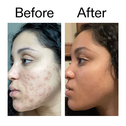 Image 1 - A split image shows a persons face in profile, with the left side showing skin with acne and the right side showing the same skin clear, captioned Before and After. Image 2 - A smiling person with radiant skin, partly covering their mouth with their hand, is shown above the text: Why we love it, Gentle, non-drying formula, Lightweight, fast-absorbing texture, Brightens dark spots and uneven tone. Image 3 - A smear of translucent yellowish gel on a white background accompanies text describing product benefits. Text reads: Why it works 2% Tranexamic Acid REDUCES HYPERPIGMENTATION. 2% Acai Berry Extract PROMOTES EVEN SKIN TONE. 2% Vitamin C Derivative BRIGHTENS SKIN TONE. Image 4 - A hand with brown skin tone holds a pea-sized amount of yellowish, clear gel on the fingertip, next to text that reads: How to use USE AM/PM. PEA-SIZED AMOUNT. MASSAGE ONTO FACE AND NECK, OR TARGETED CONCERN AREAS. AFTER CLEANSER, BEFORE MOISTURISER AND SPF IN THE AM. Image 5 - A close-up of a yellowish liquid with visible swirls and texture on a light background shows text that reads How to layer your routine, followed by a numbered list: 1 CLEANSE, 2 HYDRATE, 3 TREAT (with 3 circled), 4 MOISTURISE, 5 SPF.