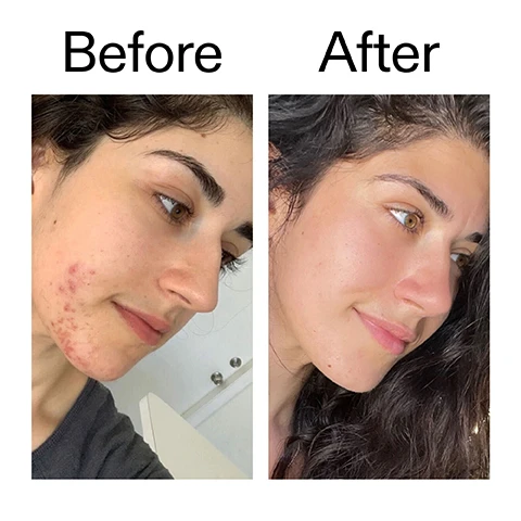 Image 1 - A split image shows a woman with significant acne on her chin and jawline on the left and smooth, clear skin on the right, with the text Before After. Image 2 - A close-up of a persons nose and cheek with visible skin texture and a few small blemishes, above text that reads 95% said blemishes were visibly improved in 12 hours* and *4-week independent clinical study of 22 people under dermatological and ophthalmological control. Image 3 - Close-up of a persons face showing the eye, cheek, and nose, with text reading 95% said imperfections were visibly improved in 12 hours*, 91% said redness appeared reduced in 4 hours*, 100% said it felt gentle on the skin*, *4-week independent consumer trial of 22 people under dermatological control. Image 4 - A close-up of a persons face with smooth, hydrated skin and hands touching their cheek, accompanied by the text Why we love it, Non-drying, non-irritating, Reduces blemishes and unclogs pores, Creamy, lightweight and fast-absorbing. Image 5 - An image detailing skincare ingredients on a white background with a green cosmetic product swash on the right, listing Why it works, 2% Succinic Acid REDUCES BLEMISH SIZE AND OIL., 2% Sulfur UNCLOGS PORES AND PREVENTS BREAKOUTS., 1% Salicylic Acid GENTLY EXFOLIATES., 0.4% Hyaluronic Acid HYDRATES SKIN. Image 6 - A close-up of three fingers shows a dollop of light green gel on the middle finger, with text overlayed reading How to use, USE AM + PM AS NEEDED, APPLY TO CLEANSED, DRY SKIN DIRECTLY ON BLEMISH, LEAVE FOR AT LEAST 4 HOURS, TOP UP AS NEEDED. Image 7 - A white background features a wavy green smudge at the bottom and text that reads How to layer your routine, with a numbered list beside it: 1 CLEANSE, 2 HYDRATE, 3 TREAT (circled), 4 MOISTURISE, 5 SPF.