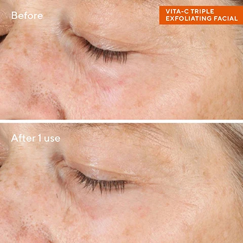 image 1, before and after 1 use. image 2, clinically proven to smooth texture as effectively as a microdermabrasion facial in one use. 87% saw brighter skin 2 weeks. 97% saw smoother skin in 2 weeks. 81% saw more even tone and less visible dark spots in 4 weeks. 81% saw healthier looking skin in 4 weeks. image 2, vita-c complex = ensures the stability and potency of vitamin c to brighten skin. physical exfoliators = micro mineral exfoliants remove dead surface cells to dramatically smooth. enzymatic exfoliators = high performing enzymes dissolve oil debris and dulling dead cells to reveal fresh, radiant skin. chemical exfoliators = glycolic acid, lactic AHAs and salicylic acids BHSs, exfoliates, brighten and purify pores. image 3, bright skin days, every day. a boost of barrier strengthening radiance for all skin types and tones. 1 = cleanse with essential c cleanser, rinse and pat dry. 2 = massage onto skin, leave on for up to 10 minutes, wet hands and rinse off, pat dry. use 2-3 times per week. 3 = smooth essential c firming radiance day cream over face, neck and chest. 4 = apply city skin age defense SPF 50 over face, neck and chest for 100% mineral UV defense.
