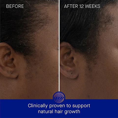 Image 3 - Side-by-side comparison of a persons hairline before and after 12 weeks of treatment, with visible text stating BEFORE on the left and AFTER 12 WEEKS on the right, along with the text Clinically proven to support natural hair growth at the bottom.
Image 4 - An image showing two comparisons of the same persons hair: the left side labeled Before shows sparse hair, while the right side labeled After 12 Weeks displays fuller, healthier hair with text at the bottom stating Clinically proven to support natural growth and boost shine.
Image 5 - A metallic orange bottle of Augustinus Bader scalp treatment is positioned on a textured surface with droplets of water surrounding it, featuring text that reads Clinically Proven Results, Hair hydration is increased by 74%, Hair strength is increased by over 2x, and Hair count is increased by 22%, along with a note about a clinical trial.
Image 6 - An image showing a brown bottle of hair treatment with a dropper, alongside text indicating user proven results: 95% agree scalp dryness feels reduced, 94% agree natural hair growth is visibly improved, 94% agree hair appears thicker, with a footnote about a consumer perception study.
Image 7 - An orange cylindrical bottle labeled Augustinus Bader sits against a blue background, with text highlighting various ingredients and benefits: TFC8, Hazel Leaf Extract, Multi-Mineral Active Complex (Magnesium, Zinc + Copper), and L-Arginine, along with their respective descriptions.
Image 8 - An image depicting a hair care routine with five steps, each featuring a product; the steps are labeled 1. Cleanse: The Rich Shampoo, 2. Condition: The Rich Conditioner, 3. Renew: The Scalp Treatment, 4. Revitalize: The Leave In-Hair Treatment, and 5. Nourish: The Hair Oil.