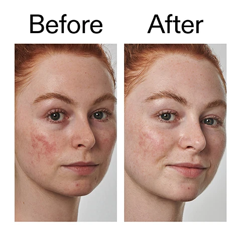 Image 1 - A side-by-side comparison of a persons face with red hair, showing a Before image on the left with visible redness and blemishes, and an After image on the right with noticeably reduced redness and clearer skin. Image 2 - A close-up of a persons smiling eyes, nose with two small piercings, and cheeks with freckles, above the text Clinically proven to minimise redness in 4 days* *Independent clinical study of 22 people. Image 3 - A close-up of a person smiling with eyes closed, hands gently pressing their cheeks, next to the text Why we love it, Lightweight texture, Calms and soothes redness, Suitable for all skin types, even the most sensitive. Image 4 - A light green viscous liquid against a white background with text that reads Why it works 10% Azelaic Acid REDUCES THE APPEARANCE OF REDNESS. 0.3% Allantoin INSTANTLY SOOTHES THE SKIN. Image 5 - A hand squeezes a white product tube labeled 1.0 US fl.oz. 10% ACID Redness La Sol, dispensing a pea-sized amount of light green serum onto a dark-toned forearm, alongside instructions that read How to use USE AM + PM. PEA-SIZED AMOUNT. MASSAGE ONTO FACE AND NECK, OR TARGETED CONCERN AREAS. AFTER CLEANSER, BEFORE MOISTURISER AND SPF IN THE AM. Image 6 - The image displays a light green, viscous liquid background with white text overlaid, reading How to layer your routine, and a numbered list: 1 CLEANSE, 2 HYDRATE, 3 TREAT (with 3 in a black circle), 4 MOISTURISE, 5 SPF.