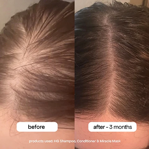 Image 1 - An image displays a before and after comparison of a scalp, with the left side showing thinner hair and more visible scalp labeled before, and the right side showing denser hair and less visible scalp labeled after - 3 months, followed by the text products used: HG Shampoo, Conditioner & Miracle Mask. Image 10 - A person is washing their long blonde hair under a stream of water, with visible text providing instructions: use 1-3 pumps, lather & rinse, repeat as necessary. Image 11 - A before and after comparison of a persons scalp and hairline, showing thinner hair on the left and denser hair on the right, with text that reads before, after - 3 months, Third Party Clinical B&A Using: HG Shampoo, Conditioner and Procapil Scalp Tonic. Image 2 - A woman with long wavy blonde hair from behind is shown next to a blue chart with yellow highlights, displaying hair growth benefits: day 1 healthy scalp = room to grow, month 1 93% saw less shedding*, month 2 3400 less strands of shedding**, month 3 thicker, fuller hair, and disclaimers: *Based on a 1-month consumer perception study with 30 participants using HG Shampoo, HG Conditioner, and HG Procapil® Tonic **Based on a 2-month dry combing analysis using bleached hair tresses using HG Shampoo, HG Conditioner, and HG Intensive Spray. Image 3 - A split image showing a persons hair before and after 3 months of treatment, with the before side showing thinner hair and the after side showing fuller, healthier hair, and text reading before, after - 3 months, and Third Party Clinical B&A Using: HG Shampoo, Conditioner and Procapil Scalp Tonic. Image 4 - A persons head with wet, lathered hair is shown with text on the left stating promotes longer + stronger-looking hair, promotes healthy scalp & follicles, and targets signs of thinning + shedding. Image 5 - A four-panel image displays a persons dark hair and scalp over time, with the top left showing a before view of a visible patch of hair loss on the scalp, the top right showing the scalp after 6 months with new hair growth covering the patch, and the bottom right showing the scalp after 1 year with full hair regrowth, all with the visible text before, after - 6 months, after - 1 year, and products used: HG Shampoo & Conditioner. Image 6 - A wooden hairbrush with white bristles heavily covered in tangled dark hair is angled on a light blue background with the text: 93% saw less shedding, 93% saw less breakage and new baby hairs, *Based on a 1-month 3rd party consumer perception study with 30 participants using HQ Shampoo, Conditioner, & Procapil® Tonic, **Based on a 3-month 3rd party consumer perception study with 30 participants using HQ Shampoo, Conditioner, & Procapil® Tonic. Image 7 - Two bottles of Bondi Boost HG Shampoo and Conditioner stand on a wet surface with water droplets, accompanied by three magnified insets on the left showing ingredients and their benefits: aloe vera balances, hydrates, and conditions; rosemary stimulates the scalp for longer, stronger hair; and peppermint helps cool and nourish dry, irritated scalp; the shampoo bottle is labeled Bondi Boost HG Shampoo, Shampooing HG, Rosemary, Horsetail Extract, Saw Palmetto, 200mL e 6.76 fl oz, and the conditioner bottle is labeled Bondi Boost HG Conditioner, Revitalisant HG, Rosemary, Saw Palmetto, 200mL e 6.76 fl oz. Image 8 - A stack of folded turquoise and beige towels with Bondi Boost Bond Repair Leave-In Mask bottles and a Bondi Boost HG Shampoo bottle nestled within them, alongside text that reads pro tip cycle between HG Conditioner for hydration and Bond Leave-In Mask 1x week for stronger strands and damage repair. Image 9 - A man with a beard looks directly at the camera while showering, with shampoo lather in his dark hair, and visible text reads fuller, stronger, healthier-looking hair for men & women.