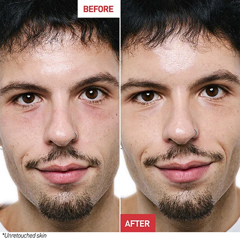 Image 1 - A close-up image of a mans face showing a before and after comparison: the left side labeled BEFORE shows redness and blemishes, while the right side labeled AFTER shows clearer skin; both sides have a visible nose ring and facial hair.
Image 2 - Image of a bottle of Erborian Korean Skin Therapy serum displayed against a pastel cloud background, with visible text highlighting its ultra-concentrated formula and seven multi-perfecting benefits: skin texture, uniformity of skin tone, brightness, fine lines and wrinkles, plumped appearance, nutrition, and suppleness.
Image 3 - Image of an amber serum bottle with a dropper, surrounded by text highlighting key ingredients: ULTRA-CONCENTRATED KOREAN SERUM FORMULATED WITH 17 SUPER INGREDIENTS INCLUDING RED PEPPER ADDS RADIANCE, ALLANTOINE SOOTHES THE SKIN, HYALURONIC ACID HYDRATES AND PLUMPS, WHITE & RED GINSENG COMPLEX SMOOTHS SKIN, YUZU ANTI-OXYDANT, CENTELLA ASIATICA KOREAN SUPER INGREDIENT FOR ITS SOOTHING PROPERTIES, + 10% PHA REFINES SKIN TEXTURE.
Image 4 - A woman with straight black hair is holding a small bottle of Erborian Korean skin therapy in her right hand while gazing at the camera, with a pastel-colored sky in the background; the image includes text stating that after 1 night, 97% said the texture of their skin was soother and after 28 nights, 87% said the product gave them more confidence in their skin.
Image 5 - An image featuring two serum bottles on a soft, pastel background; the left bottle is labeled Skin Therapy Milky-Serum, described as having a milky texture and best for combination to oily skin, while the right bottle is labeled Skin Therapy Oil-Serum, described as having an oil texture and best for normal to dry skin, along with the text indicating 7 benefits and 17 super ingredients.