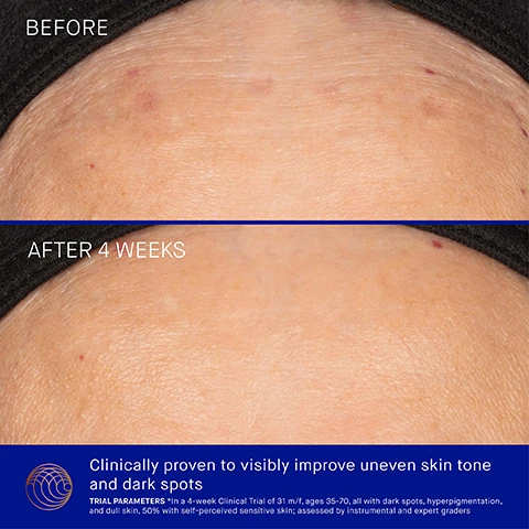 Image 1 - A split image of skin shows a top section labeled BEFORE with noticeable dark spots and uneven tone, and a bottom section labeled AFTER 4 WEEKS displaying significantly reduced spots and a more even skin tone, followed by text on a blue background: Clinically proven to visibly improve uneven skin tone and dark spots TRIAL PARAMETERS *In a 4-week Clinical Trial of 31 m/f, ages 35-70, all with dark spots, hyperpigmentation, and dull skin, 50% with self-perceived sensitive skin; assessed by instrumental and expert graders. Image 2 - A gold pump bottle of Augustinus Bader The Vitamin C Serum with Advanced TFC8, 30 ml, is shown against a blue background with white product smears, next to the title Clinically Proven Results and bullet points: Radiance and luminosity improved by 32%, Uneven skin tone reduced by 50%, and Skin texture and smoothness improved by 35%, with a footnote reading In a 4-week Clinical Trial of 31 m/f, ages 35-70, all with dark spots, hyperpigmentation, and dull skin, 50% with self-perceived sensitive skin; assessed by instrumental and expert graders. Image 3 - Close-up of a persons face with a hand gently touching the cheek, displaying text that reads: User Proven Results, 88% said skin looked visibly brighter, 97% felt skin texture was softer and smoother, 100% experienced no redness or irritation, *In a 4-week Consumer Perception Study of 109 m/f, ages 18-70, 50% with self-perceived sensitive skin. Image 4 - A gold serum bottle is centered on a deep blue background with a white, cream-like swirl behind it, and includes the text ADVANCED TFC8® An exclusive complex featuring a proprietary, biomimetic delivery system that supports skin cell renewal, VITAMIN C (ASCORBYL GLUCOSIDE) Brightens and evens skin while helping to neutralize free radicals, ERGOTHIENEINE Supports efficacy of Vitamin C, evens skin tone and smooths texture, ALGAE EVENING COMPLEX Visibly reduces redness, uneven pigmentation and dark spots, and on the bottle AB Augustinus Bader, THE VITAMIN C SERUM WITH ADVANCED TFC8®, LE SÉRUM VITAMINE C AVEC TFC8® OPTIMISÉ, 30 ml e 1 fl. oz. Image 5 - The image displays two Augustinus Bader serum products side-by-side, the left featuring an orange bottle on a blue background for The Serum and the right a gold bottle on a white background for The Vitamin C Serum, detailing their properties: The Serum bottle reads AB Augustinus Bader, THE SERUM WITH TFC8®, LE SÉRUM AVEC TFC8®, 30 ml e 1 fl. oz., and its description includes Key Ingredients TFC8® | Edelweiss Extract | Polysaccharide Moisture Complex, Texture Lightweight cream serum, Key Benefits Firming & Hydrating, Key Concerns Loss of elasticity, fine lines and wrinkles, skin barrier function, dryness, dullness, and Ideal For All skin types; The Vitamin C Serum bottle reads AB Augustinus Bader, THE VITAMIN C SERUM WITH ADVANCED TFC8®, LE SÉRUM VITAMINE C AVEC TFC8® OPTIMISÉ, 30 ml e 1 fl. oz., and its description includes Key Ingredients Advanced TFC8® | Vitamin C | Ergothioneine, Texture Cushiony, water-light serum, Key Benefits Evening & Illuminating, Key Concerns Dark spots, dullness/uneven tone, free radical damage, loss of firmness, and Ideal For Dull, uneven, and sun-damaged skin types. Image 6 - The image shows a woman holding a golden Augustinus Bader The Vitamin C Serum bottle, a close-up of a drop of clear serum on a persons cheek, and accompanying text instructions: Step 1 Dispense 2 pumps into hands. In upward sweeping motions, smooth over the face, neck and decollete until fully absorbed. Step 2 Follow by applying your Augustinus Bader moisturizer, eye cream and sunscreen. Image 7 - A four-step Augustinus Bader skincare routine, organized with products shown in white sections against a blue background, includes the following text: The Routine. 1. Cleanser, featuring a navy jar and a blue tube, with the titles The Cleansing Balm / The Foaming Cleanser. 2. Serum, featuring a gold bottle, with the title The Vitamin C Serum. 3. Moisturizer, featuring two navy bottles, with the titles The Cream / The Rich Cream. 4. Sunscreen, featuring a white bottle, with the title The Sunscreen SPF 50.